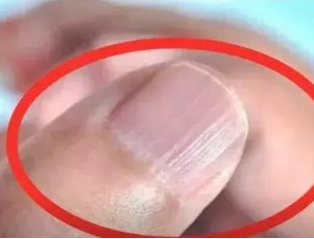 91免费看视频软件网站厂家分析手指甲有竖纹的根本原因 91免费看视频软件网站厂家分析手指甲有竖纹的根本原因